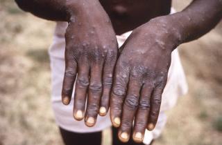 UAE Is First Gulf State to Report Monkeypox