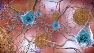 This Could Be a 'Momentous, Historic' Moment in Fight Against Alzheimer's