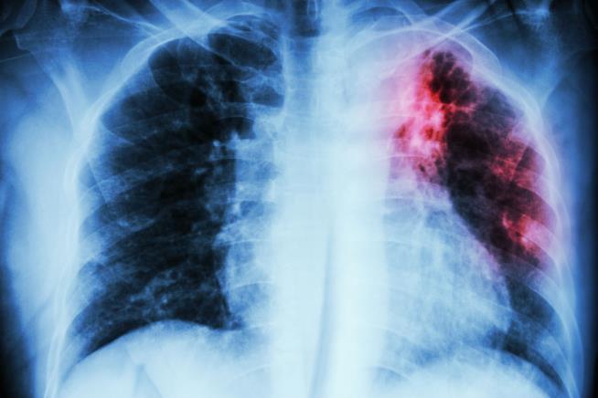 For More Than a Year, Washington Woman Has Refused to Get Treatment for Tuberculosis
