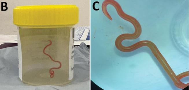 In First, Doc Pulls Live Worm From Human Brain