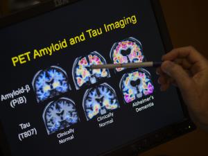 Growing Focus in Dementia: a Diagnosis of 'MCI'