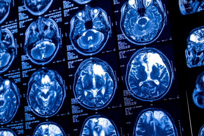 New Therapy Puts the Brakes on Huntington's Disease