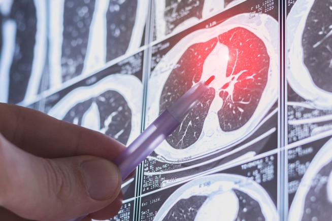 Study: Simple CT Scan Could Prevent Thousands of Deaths