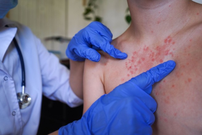 Measles Cases Surge in South Carolina as Outbreak Spreads