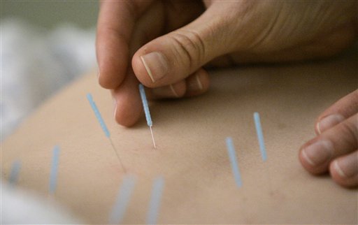 Study: Even 'Fake' Acupuncture Eases Back Pain