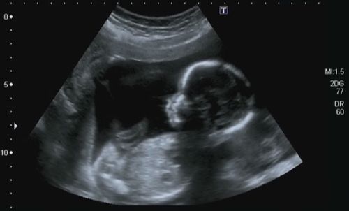 Fetus Feels No Pain Before 24 Weeks: Study