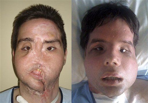 Man Shows Off Full Face Transplant