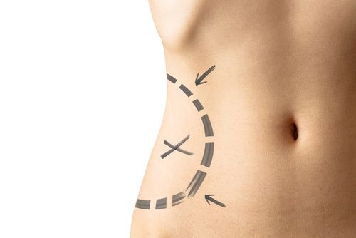 Liposuction Fat Reappears On Arms, Belly