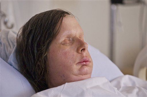 face transplant after chimpanzee attack