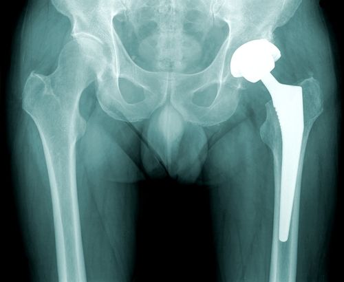 J&J Hawked FDA-Banned Hip Replacement Overseas