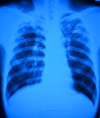 25 Calif. Babies May Have Been Exposed to TB
