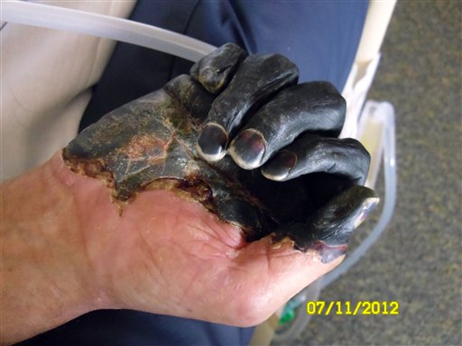 Oregon Man Hit With Plague Could Lose Fingers