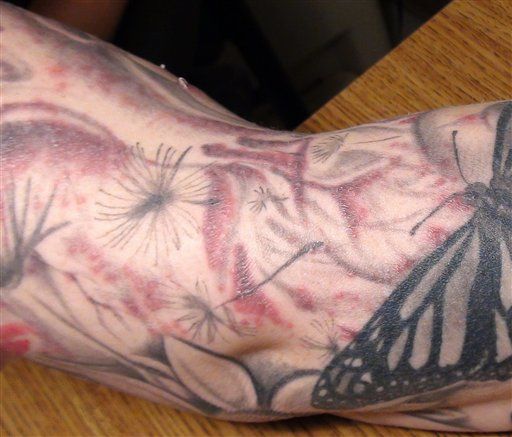 Bad Water in Ink Blamed for Tattoo Infections