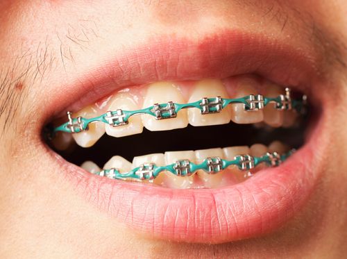 Lawsuit: 11 Years in Braces Rotted Guy's Teeth