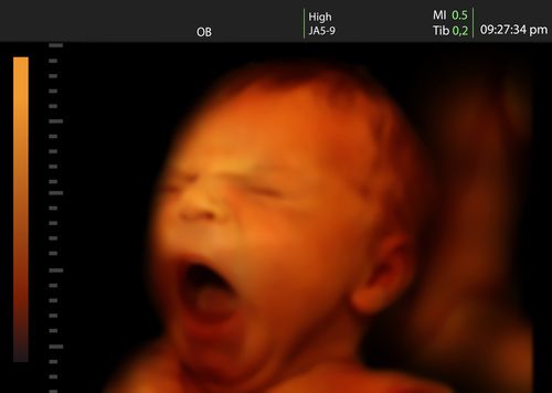 Scans Show Fetuses Do Yawn
