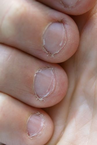 Man Dies of Heart Attack Caused by ... Nail Biting
