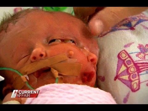 Rarest of Twins Born With Single Body