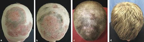 Arthritis Drug Makes Hairless Man Very Hairy