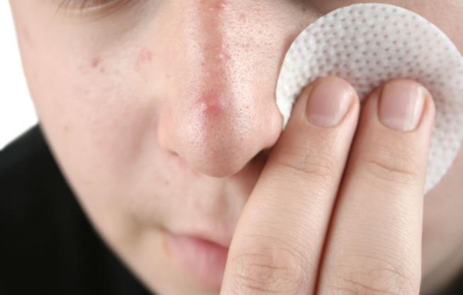 FDA Warns of Severe Acne Product Reactions