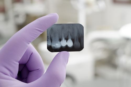 Doctors Find Extra Tooth in Really Odd Place