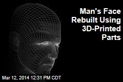 Man&#39;s Face Rebuilt Using 3D-Printed Parts