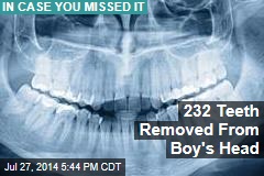 232 Teeth Removed From Boy&#39;s Head