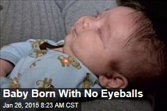 Baby Born With No Eyeballs