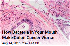 How Bacteria in Your Mouth Make Colon Cancer Worse