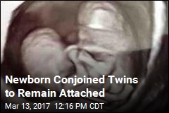 Born &#39;Healthy,&#39; Hard Part Begins for Conjoined Twins