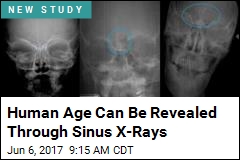 Human Age Can Be Revealed Through Sinus X-Rays