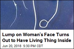 Lump on a Woman&#39;s Face Turns Out to Be a Worm