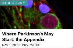 Appendix Removal Tied to Lower Parkinson&#39;s Risk