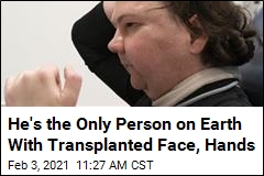 A Face, Hands Transplant May Succeed for First Time Ever