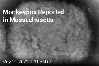 Monkeypox Reported in Massachusetts