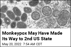 NYC Investigates Possible Monkeypox Case