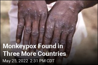 UAE Is First Gulf State to Report Monkeypox
