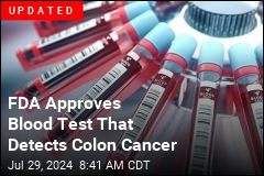 Colon Cancer Blood Test Shows Promise for Early Detection