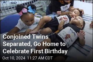 Conjoined Twins Are Separated in Time to Celebrate First Birthday