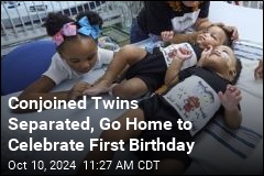 Conjoined Twins Are Separated in Time to Celebrate First Birthday