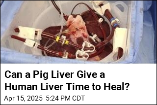 Trial Will See If Pig Livers Can Help Humans With Liver Failure