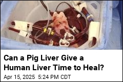 Trial Will See If Pig Livers Can Help Humans With Liver Failure