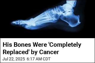 Swollen Finger, Toe Alert Docs to Spread of Rare Cancer
