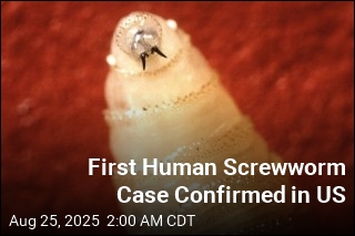 First Human Screwworm Case Confirmed in US
