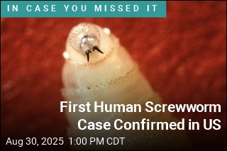 First Human Screwworm Case Confirmed in US