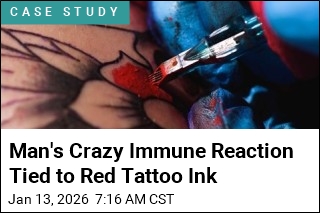Man's Crazy Immune Reaction Tied to Red Tattoo Ink