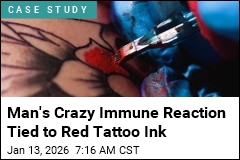 Man's Crazy Immune Reaction Tied to Red Tattoo Ink