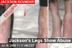 Jackson's Legs Show Abuse